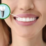 The Different Types Of Dental Implants